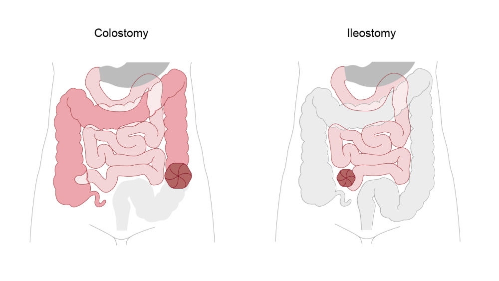 Darstellung von Kolostomie und Ileostomie